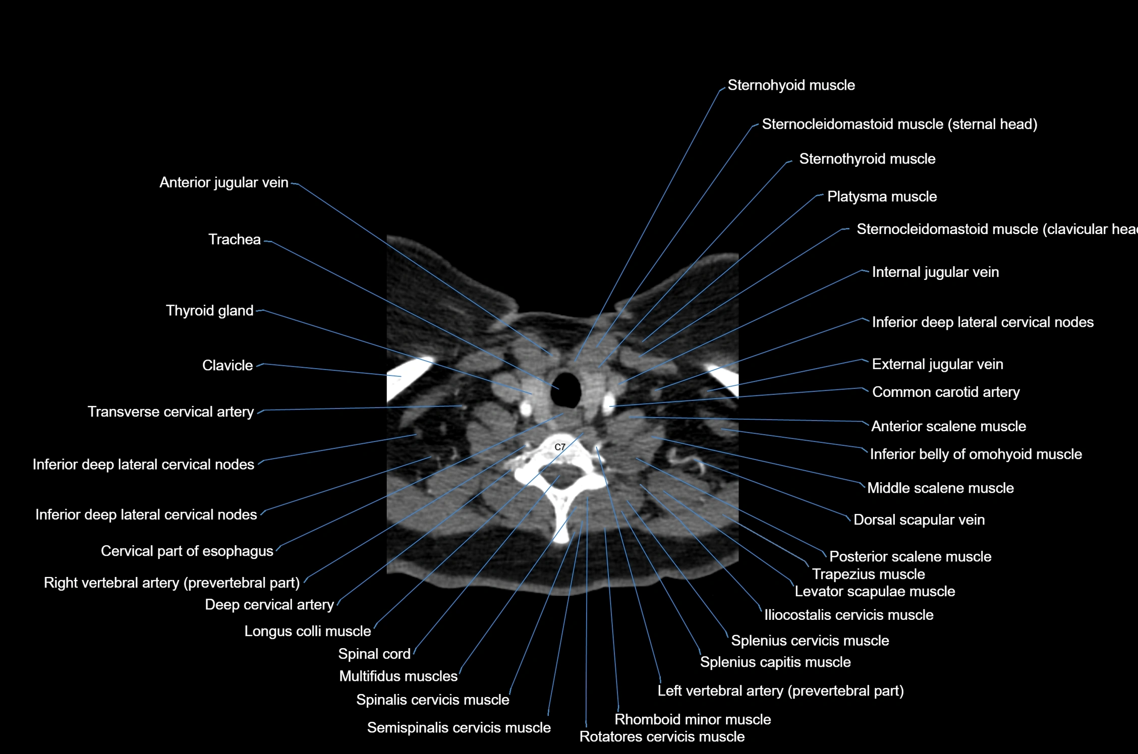 CT Neck axial cross sectional anatomy radiology image-img-00001-00049.webp